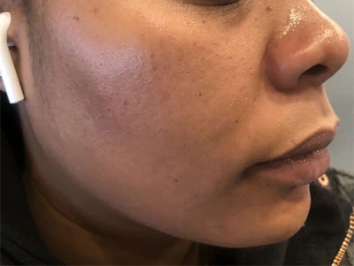 Acne Treatment Before and After Before and after photos showing a person's skin with reduced acne after treatment