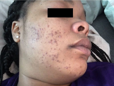 Acne Treatment Before and After Before and after photos showing a person's skin with reduced acne after treatment
