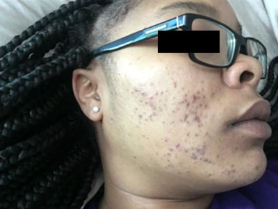 Acne Treatment Before and After Before and after photos showing a person's skin with reduced acne after treatment